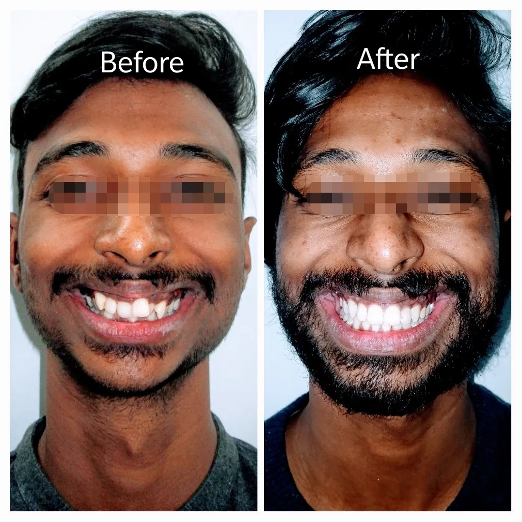 braces before and after bhopal 4